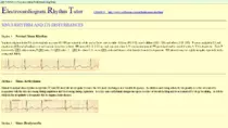 sites pics/ECG/EKG_RHYTHM_TUTORIAL_-_2016-04-09_15.35.41.png