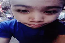 images/portfolio/modals/pimples.jpg